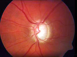 druckgesch�digte, abgeblasste Glaukompapille