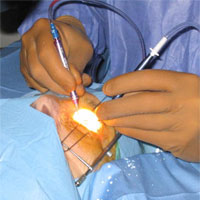 beidh�ndige Absaugung des Linsenmaterials (s. OP-Video)